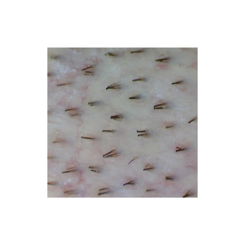 Firefly Video Dermatoscope DE350 (wireless data transfer) Medvana UK