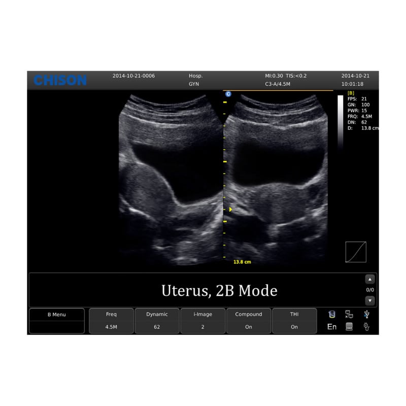 Chison ECO 1 Ultrasound Machine with rechargeable battery | linear transducer (L7M-A) Medvana UK