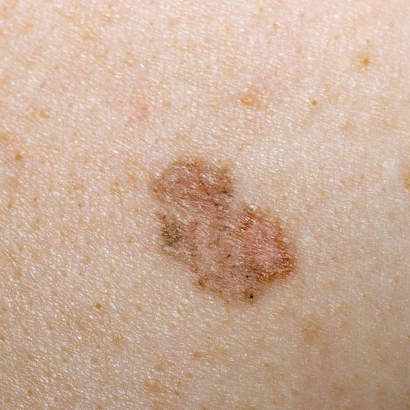 LuxaScope CCT Dermatoscope without scaling Medvana UK