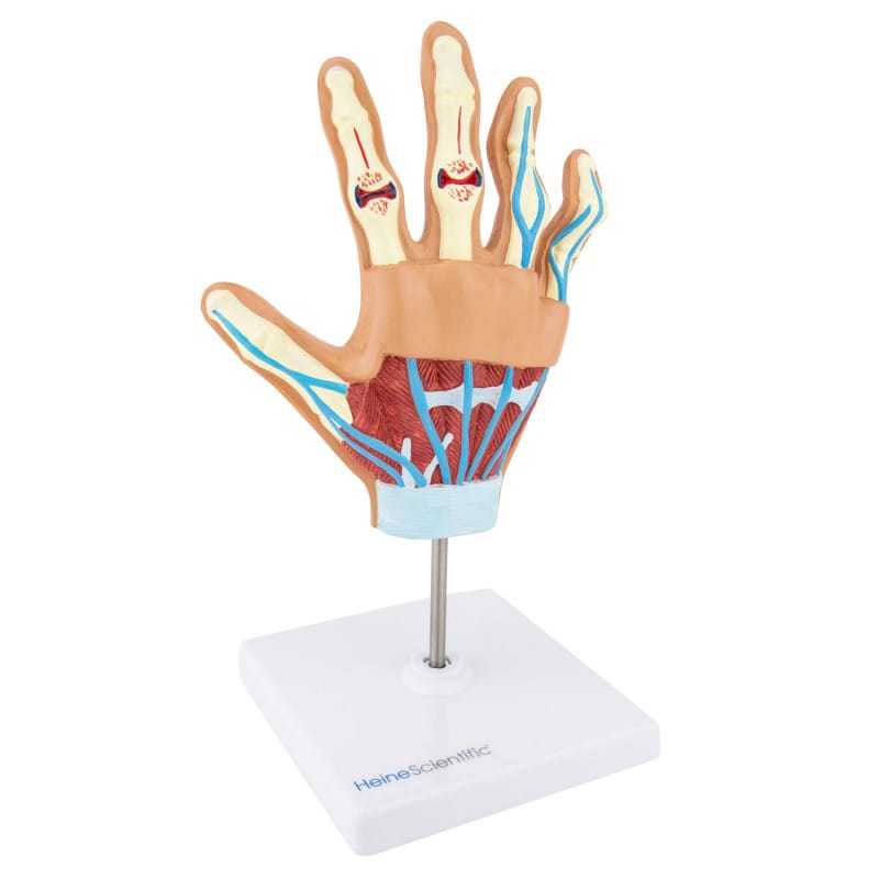 Hand Model with Rheumatoid Arthritis Medvana UK