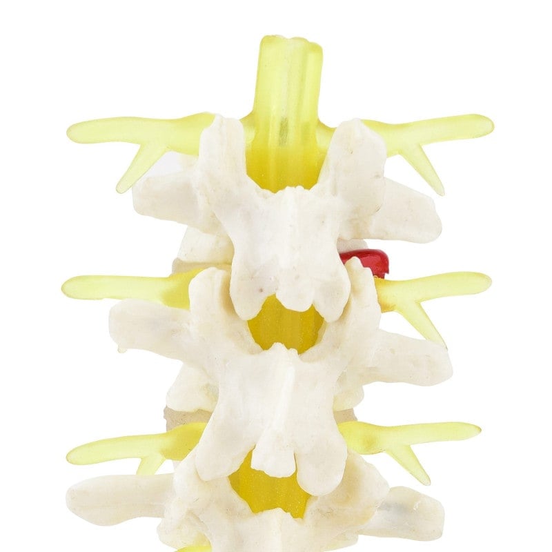 Herniated Disc Model Medvana UK