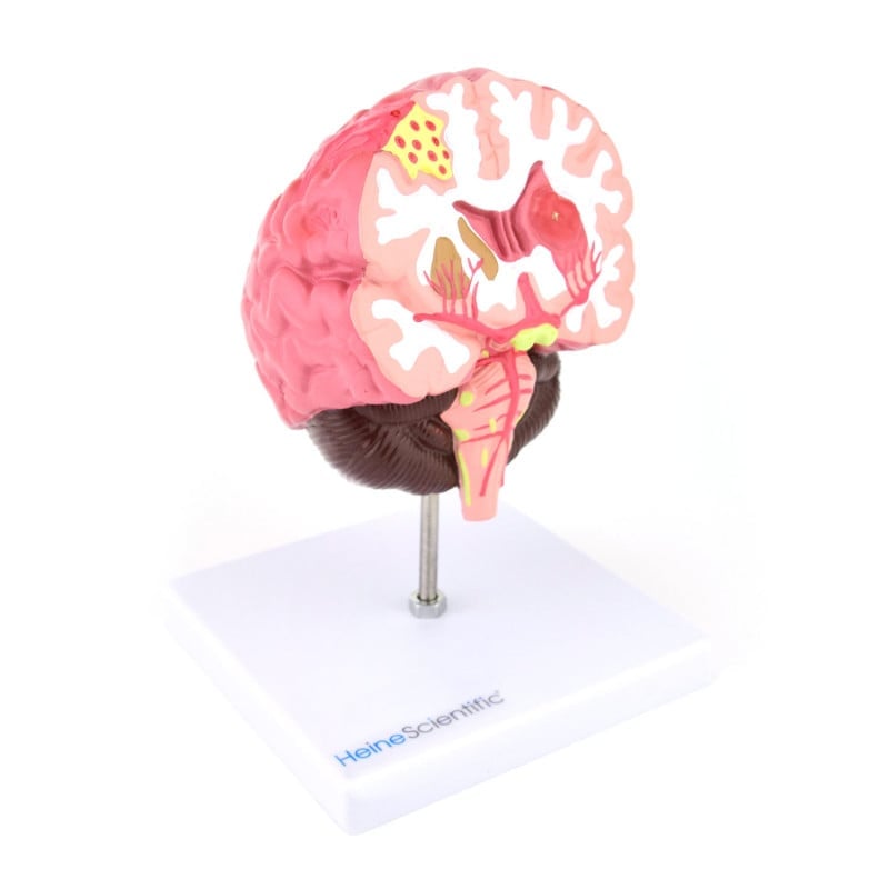 Brain Model with Diseases Medvana UK
