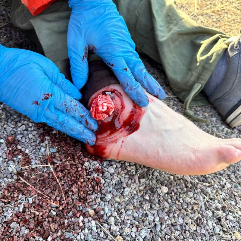Wound Moulage Open Fracture Ankle