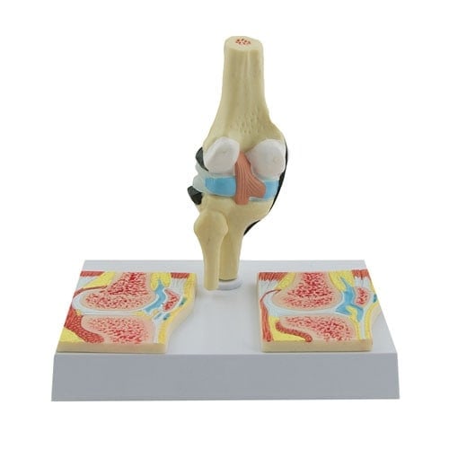 Rheumatic Knee Joint Model Medvana UK