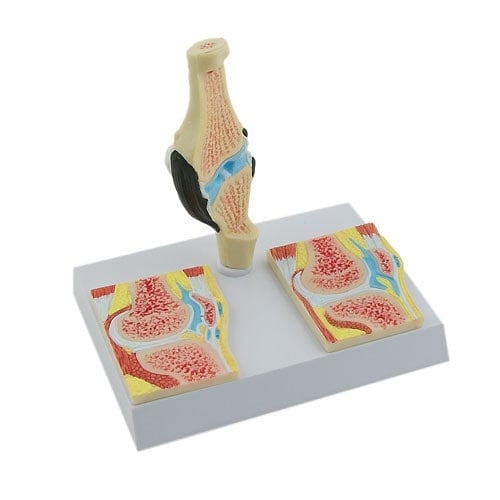 Rheumatic Knee Joint Model Medvana UK