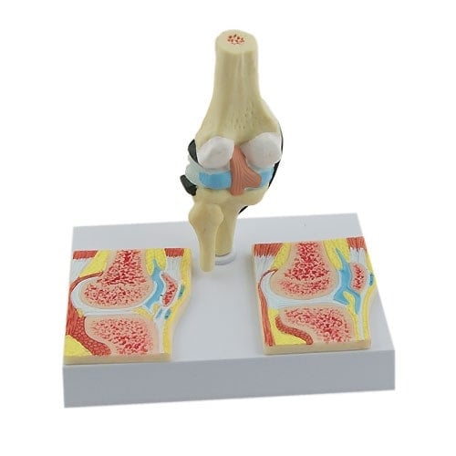 Rheumatic Knee Joint Model Medvana UK