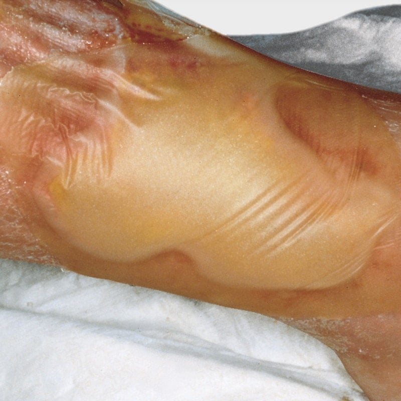 Hydrocoll Hydrocolloid Dressing 20 x 20cm Medvana UK