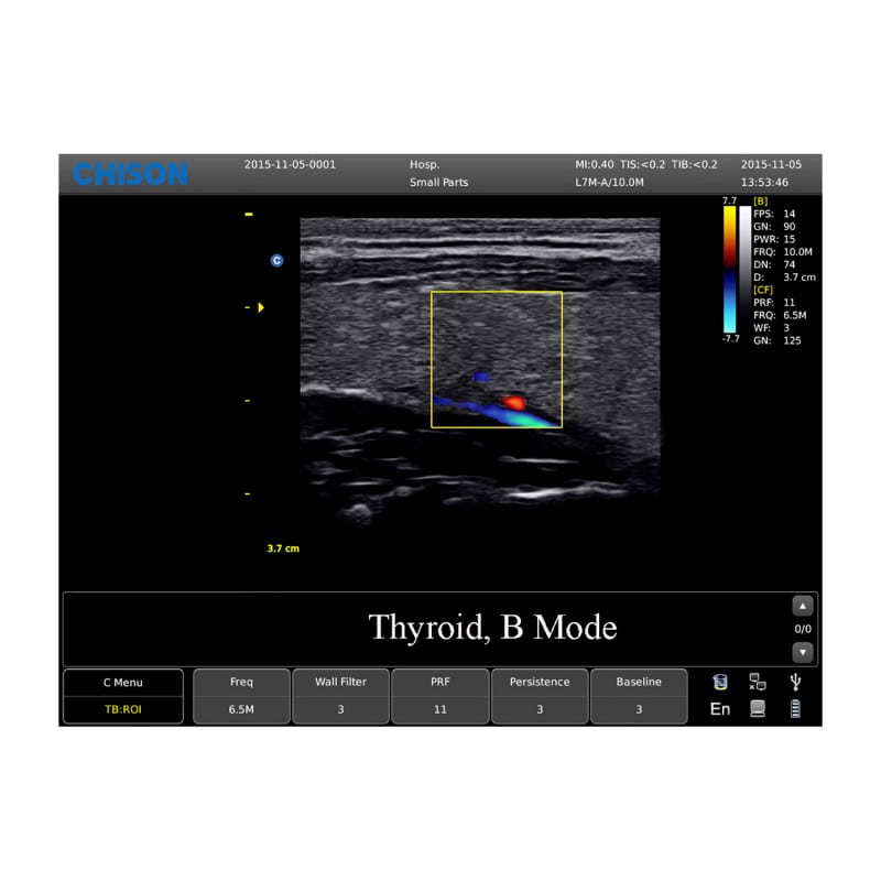CHISON ECO5 incl. Ultrasound Trolley with linear probe Medvana UK