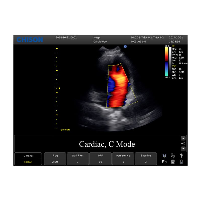 CHISON ECO5 incl. Ultrasound Trolley with linear probe Medvana UK