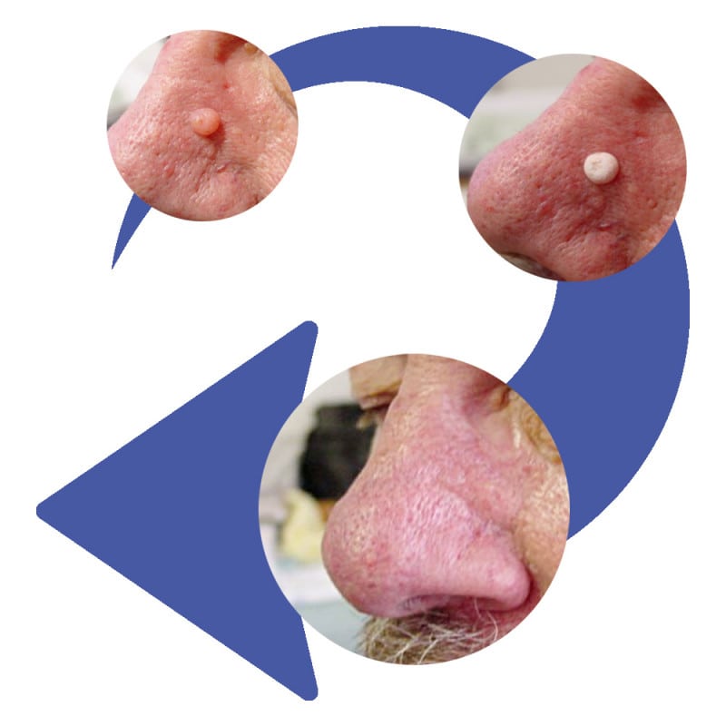 CryoPen | X+ Starter Set Medvana UK