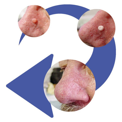 CryoPen | X+ Standard Medvana UK