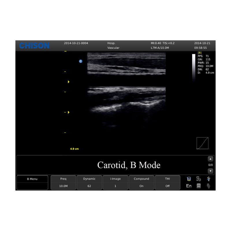 Chison ECO 1 Ultrasound Machine without rechargeable battery | linear transducer (L7M-A) Medvana UK