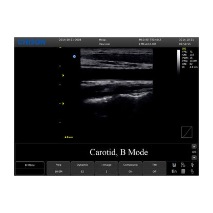 Chison ECO 1 Ultrasound Machine with rechargeable battery | convex transducer (C3-A) Medvana UK