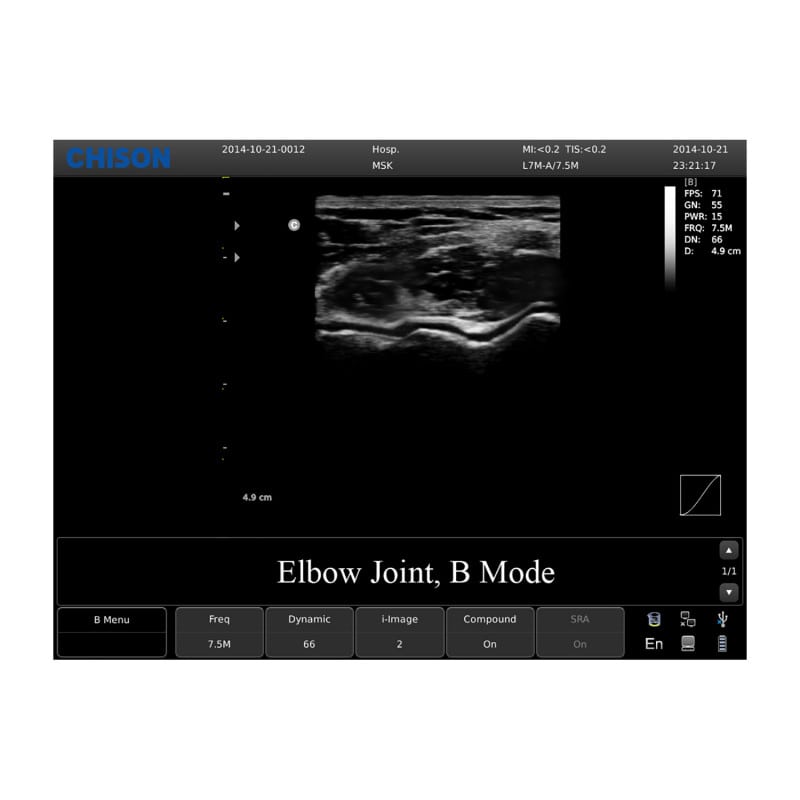 Chison ECO 1 Ultrasound Machine with rechargeable battery | linear transducer (L7M-A) Medvana UK
