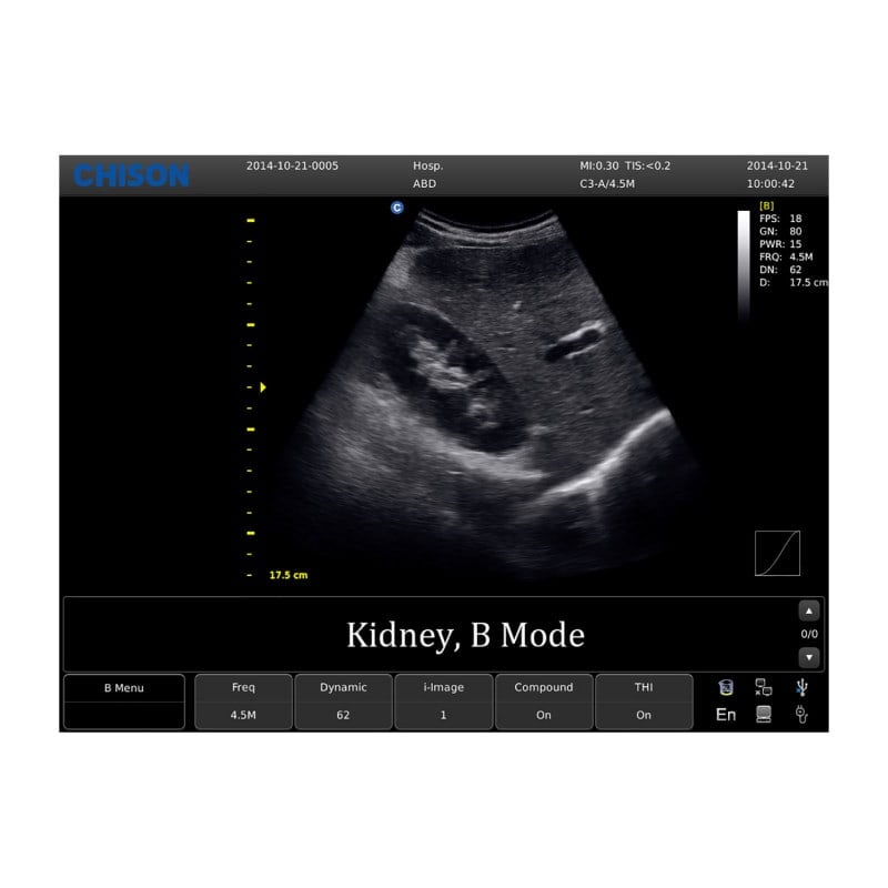 Chison ECO 1 Ultrasound Machine with rechargeable battery | convex transducer (C3-A) Medvana UK
