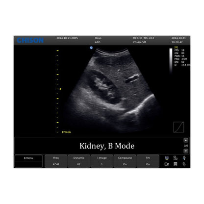 CHISON ECO1 incl. Ultrasound Trolley without battery | with convex probe Medvana UK
