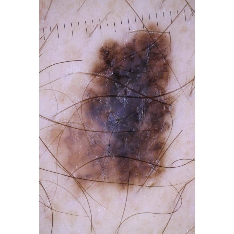 DermLite Foto II Pro Medvana UK