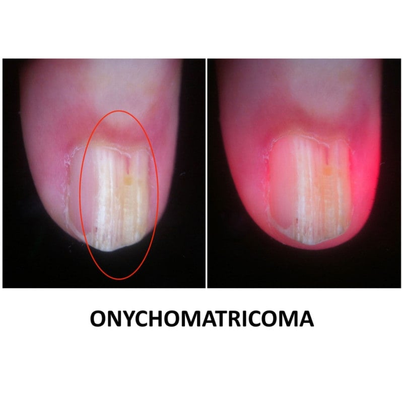 DermLite Foto X with Nailio Medvana UK