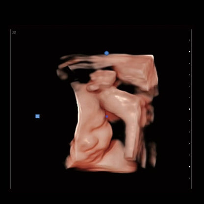 CHISON EBit 30 incl. Ultrasound Trolley with battery | with height adjustment Medvana UK