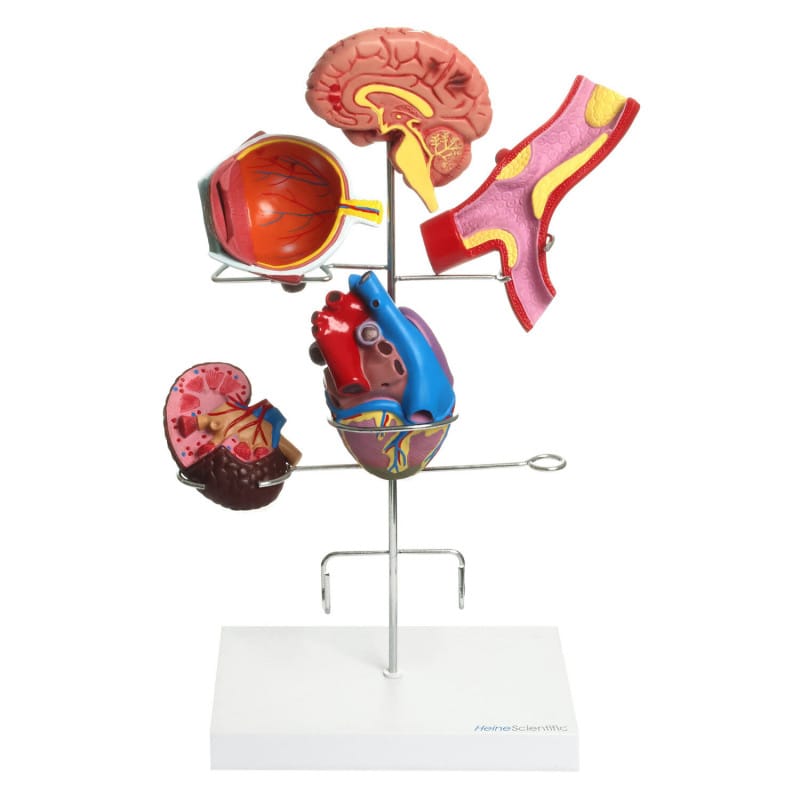 Hypertension Model Set Medvana UK