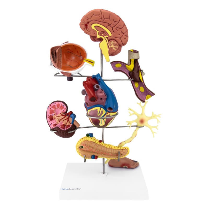 Model of Diabetes Secondary Diseases Medvana UK