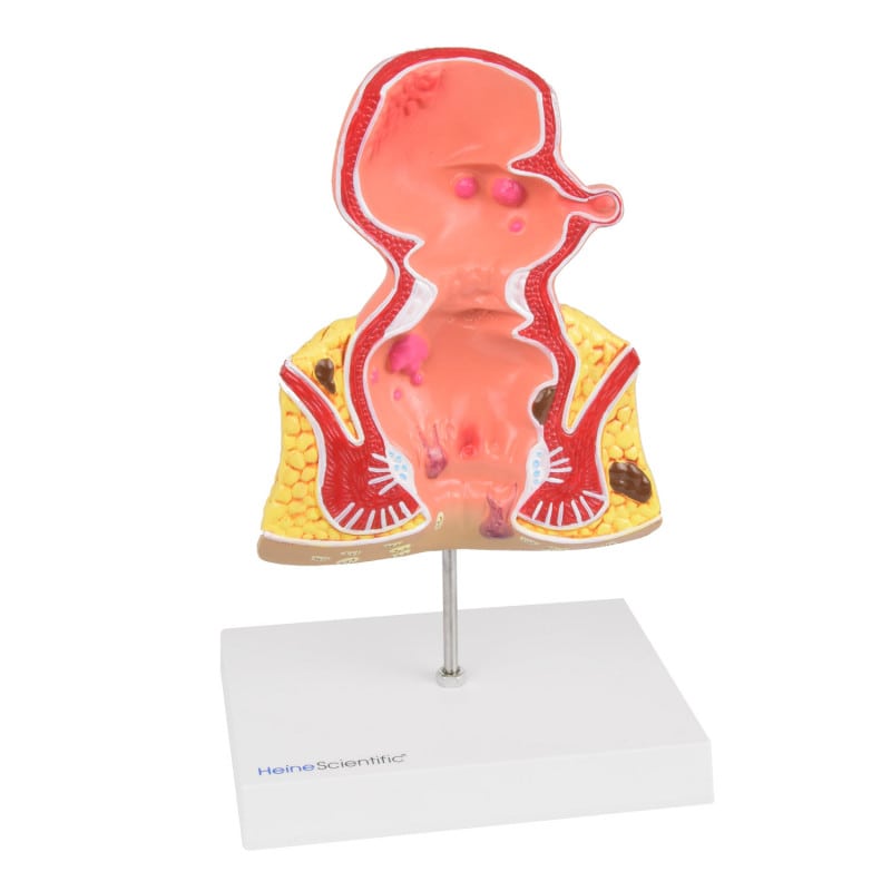 Rectum Model with Pathologies Medvana UK