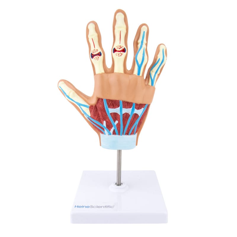 Hand Model with Rheumatoid Arthritis Medvana UK
