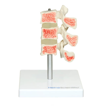 Osteoporosis Model Medvana UK