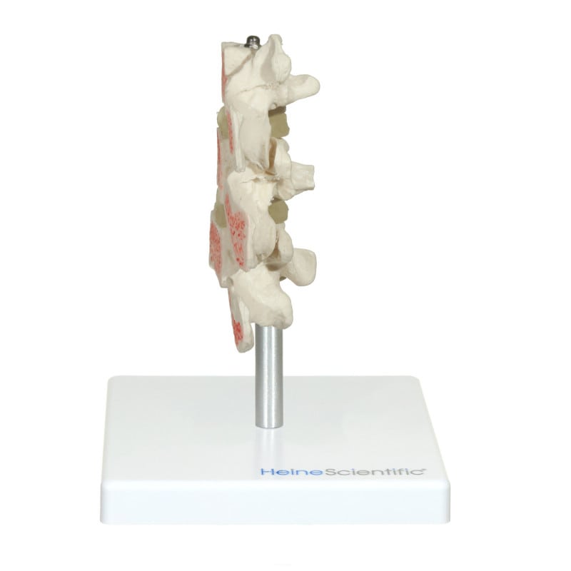 Osteoporosis Model Medvana UK