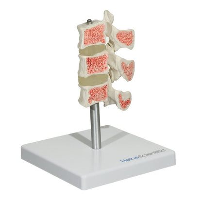 Osteoporosis Model Medvana UK