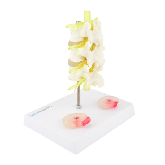 Herniated Disc Model Medvana UK