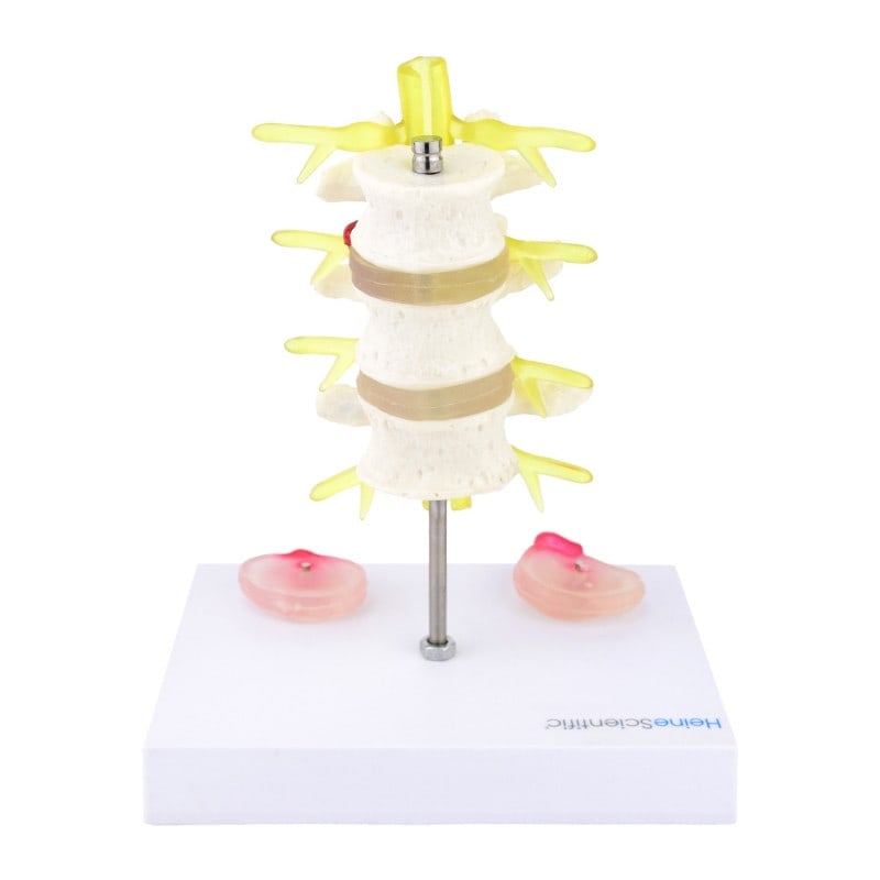 Herniated Disc Model Medvana UK