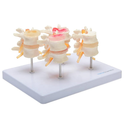 HeineScientific Intervertebral Disc Model Medvana UK