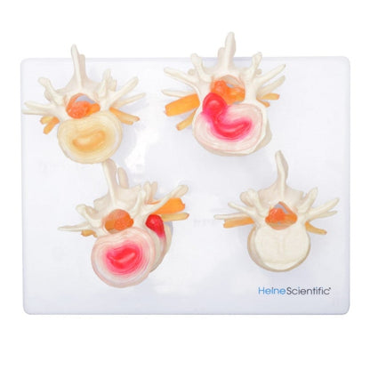 HeineScientific Intervertebral Disc Model Medvana UK