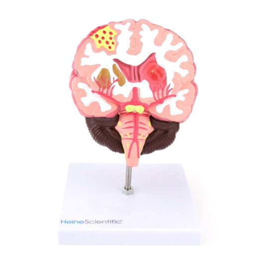 Brain Model with Diseases Medvana UK