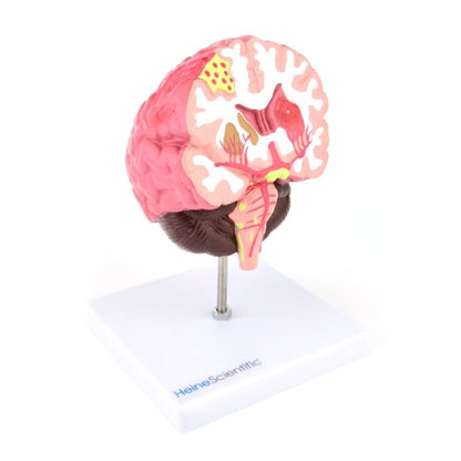 Brain Model with Diseases Medvana UK