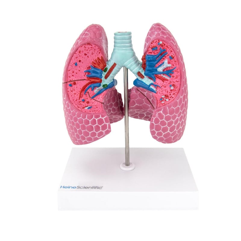 Lung Model with Diseases Medvana UK