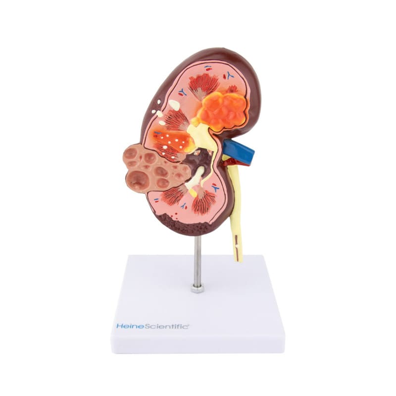 Kidney Model with Diseases Medvana UK