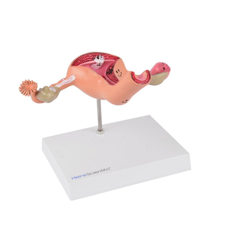 Uterus Model with Diseases Medvana UK