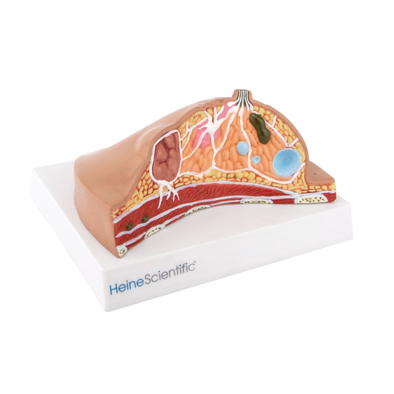 Female Breast Model with Diseases Medvana UK