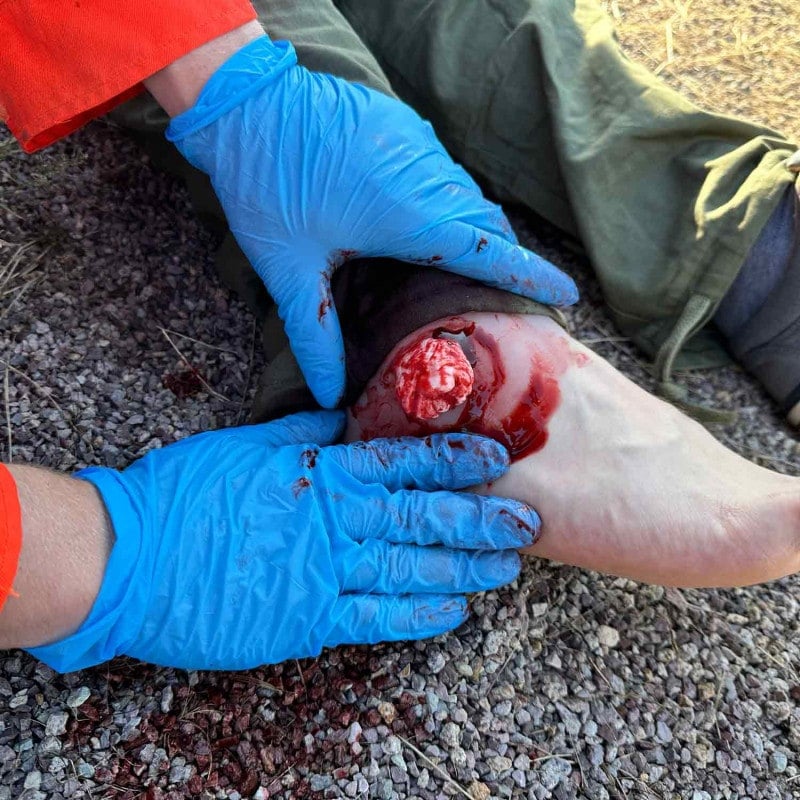 Wound Moulage Open Fracture Ankle