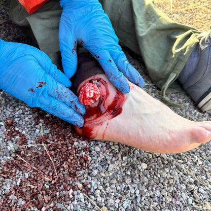 Wound Moulage Open Fracture Ankle