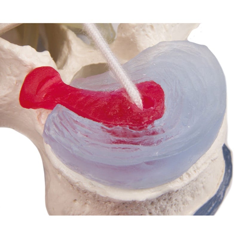 Lumbar Vertebra with Herniated Disc Medvana UK