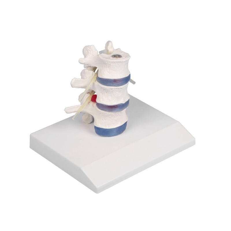 Lumbar Vertebra with Herniated Disc Medvana UK