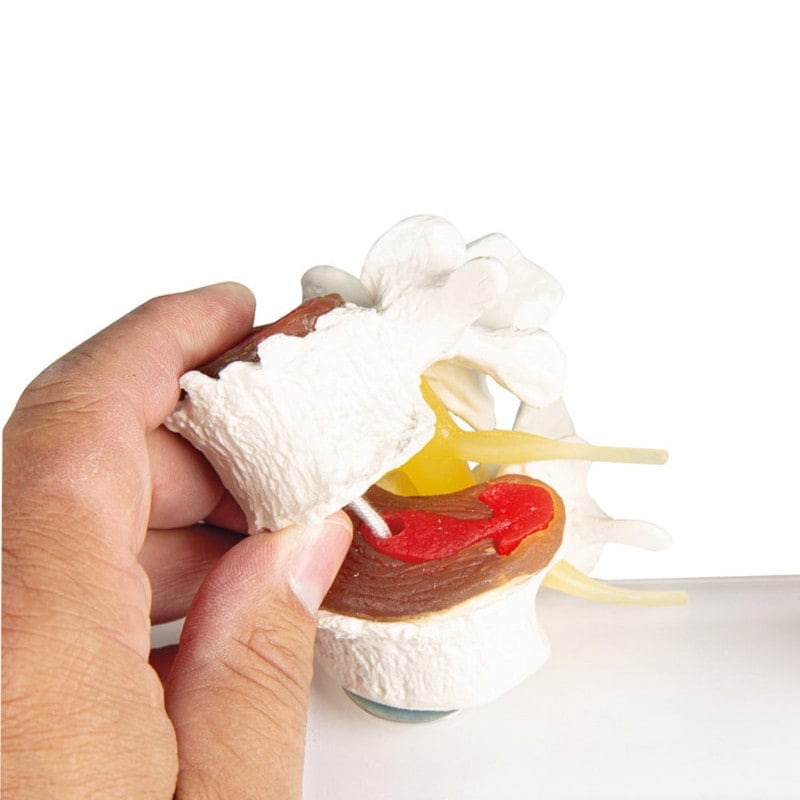 Stages of Disc Degeneration Medvana UK