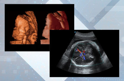 Sonoscape P15 Ultrasound Machine with battery Medvana UK