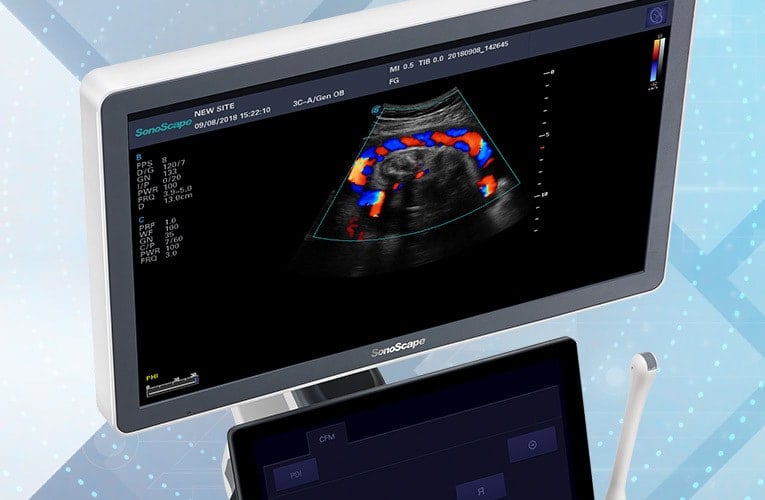 Sonoscape P15 Ultrasound Machine without battery Medvana UK