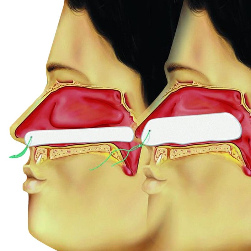 Raucocel Epistaxis Packing Medvana UK
