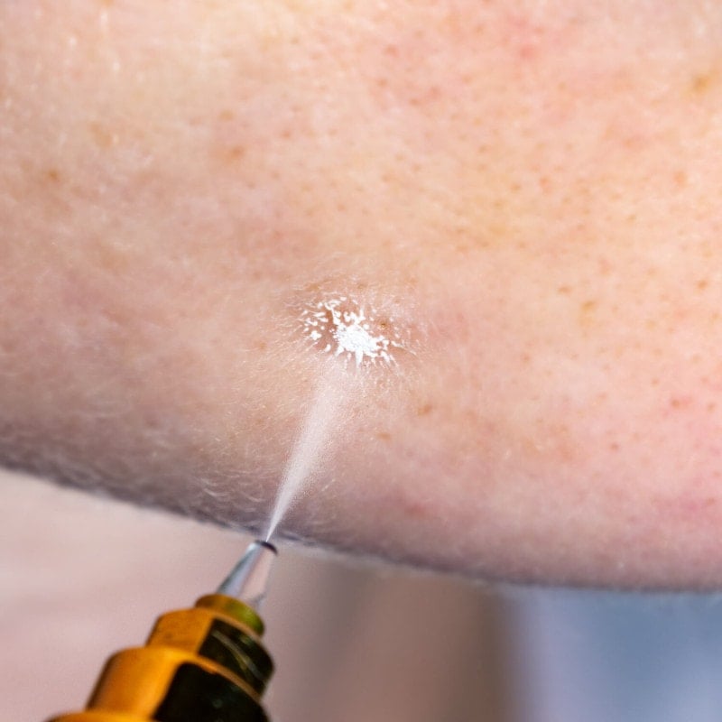 Cryoalfa SUPER Liquid | in blister Medvana UK