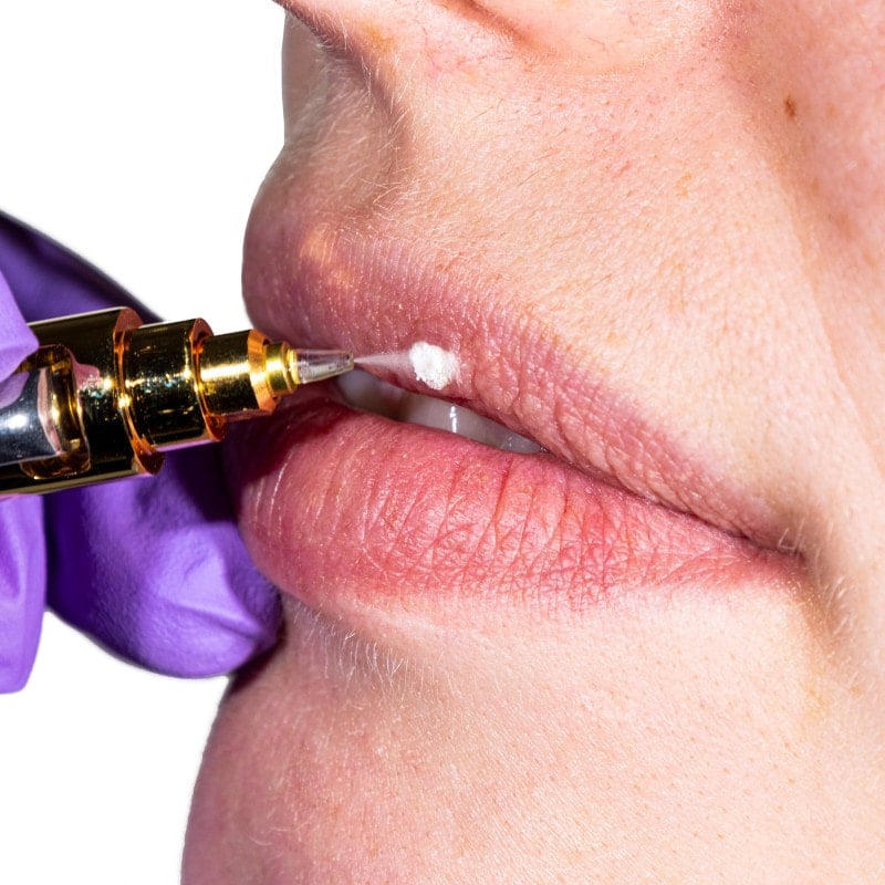 Cryoalfa SUPER Contact | in blister Medvana UK